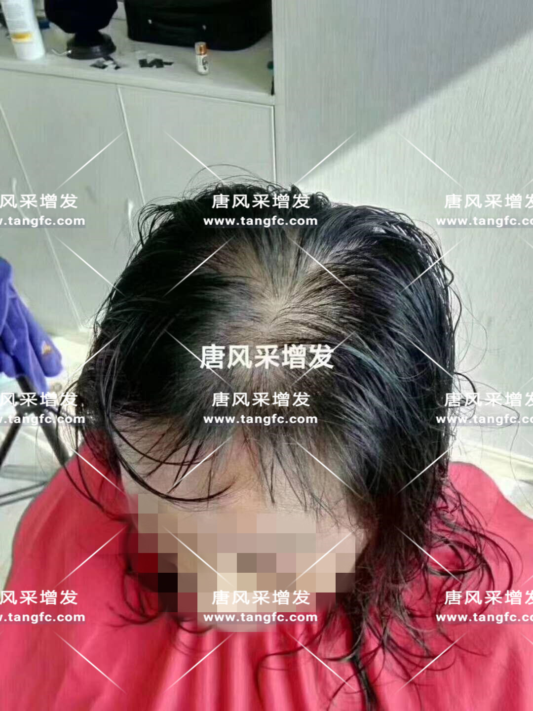 謝頂會坑一輩子？ 我不禁摸了摸自己頭發(fā)