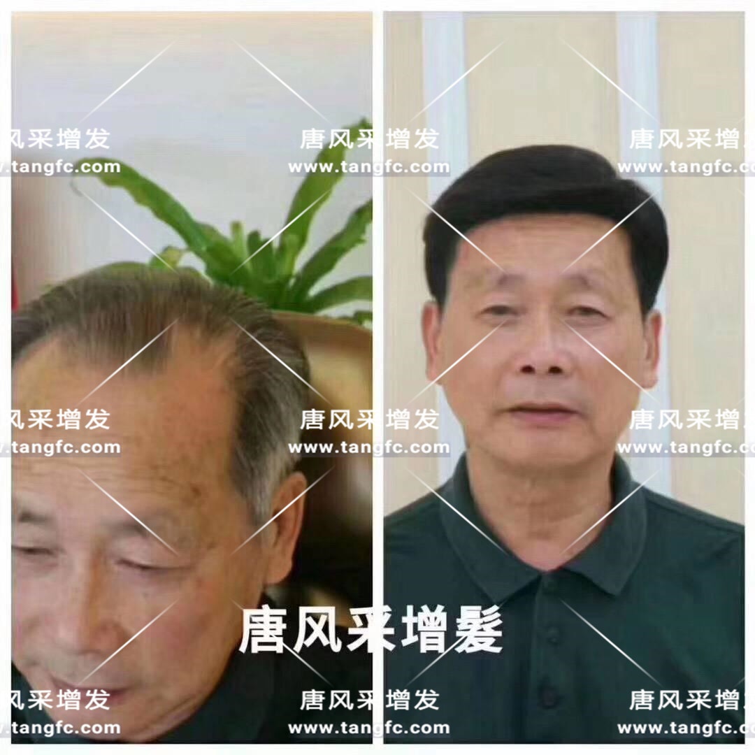 謝頂會坑一輩子？ 我不禁摸了摸自己頭發(fā)