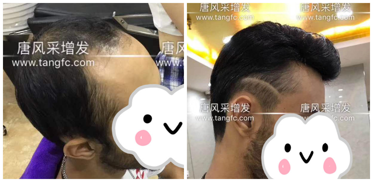 男士假發(fā)容易看出來嗎？看看做過頭發(fā)的發(fā)友怎么說！